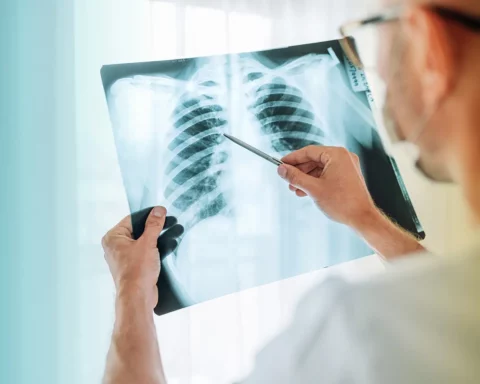 Male doctor examining the patient chest x-ray film lungs scan at radiology department in hospital